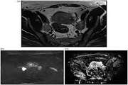 Diagnostic value of diffusion-weighted magnetic resonance imaging in discriminating between metastatic and non-metastatic pelvic lymph nodes in endometrial cancer