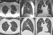 Automated detection of pneumonia cases using deep transfer learning with paediatric chest X-ray images