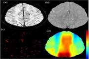 An interictal measurement of cerebral oxygen extraction fraction in MRI-negative refractory epilepsy using quantitative susceptibility mapping