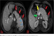 Pancreatic neuroendocrine tumor presenting as a diffuse pancreatic enlargement, case report and review of literature