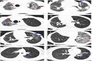 COVID-19: Unilateral Involvement of Transplanted Lung, Sparing Contralateral Fibrotic Lung