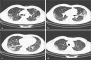 Clinical and chest CT features as a predictive tool for COVID-19 clinical progress: introducing a novel semi-quantitative scoring system