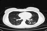 Chest CT Imaging Characteristics of COVID-19 Pneumonia in Surviving and Non-Surviving Hospitalized Patients: A Retrospective Study in a Referral Center in Tehran, Iran