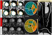 Resting-state cardiac magnetic resonance perfusion imaging accuracy in diagnosing patients with coronary artery disease: A comparison with percutaneous coronary intervention