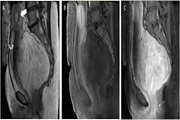 Aggressive angiomyxoma of the pelvis surgical management in a case with delayed diagnosis