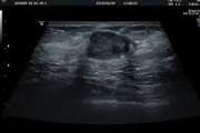 Assessment of ultrasound features and BI-RADS categories of malignant breast masses in Women ≤ 40