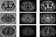 Comparison of Phase-Sensitive Inversion Recovery and Conventional Magnetic Resonance Imaging for Detection of Cortical Plaques in MS Patients