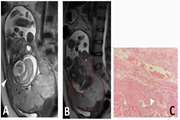 Diagnostic models for detection of intrauterine growth restriction and placental insufficiency severity, based on magnetic resonance imaging of placenta