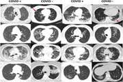 Deep COVID DeteCT: an international experience on COVID-19 lung detection and prognosis using chest CT