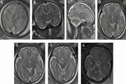 Differences in the Brain Cortical Thickness and Area of Different Lobes Between Fetuses with Intrauterine Growth Restriction and Controls Based on 3-Tesla Magnetic Resonance Imaging (MRI)