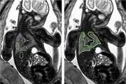 Comparison of fetal lung maturation in fetuses with intrauterine growth restriction with control group, using lung volume, lung/liver and lung/muscle signal intensity and apparent diffusion coefficient ratios on different magnetic resonance imaging sequences 