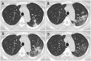 Clinical characteristics, CT features and perinatal outcome of COVID-19 pneumonia in pregnant women and comparison with non-pregnant women