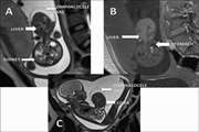 A Spectrum of Ultrasound and MR Imaging of Fetal Gastrointestinal Abnormalities. Part 2: Anorectal Malformation, Liver, and Abdominal Wall Anomalies