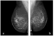 Asymmetric dense breast is an independent breast cancer risk factor