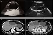 The Cystic Hepatic Mesenchymal Hamartoma in an Adult Mistaken for Hydatid Disease: Case Report