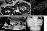 A Spectrum of Ultrasound and MR Imaging of Fetal Gastrointestinal Abnormalities. Part 1: Esophagus to Colon