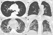 Prognostic value of inflammatory biomarkers for predicting the extent of lung involvement and final clinical outcome in patients with COVID-19