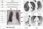 Predictors of The Chest CT Score in COVID-19 Patients: A Cross-Sectional Study