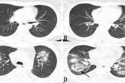 Is Target Sign (Bull’s Eye Appearance) associated with adverse outcomes in COVID-19 patients? A Case Series and Literature Review