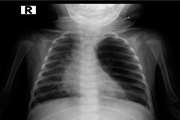 A Six-month-old Infant with Respiratory Distress and Cyanosis