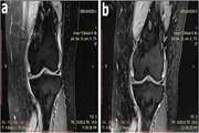 Clinical and laboratory findings following transplantation of allogeneic adipose-derived mesenchymal stromal cells in knee osteoarthritis, a brief report