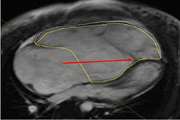 The Use of Feature Tracking Technique for the Quantification of Ventricular Strain Pattern in Patients with Ebstein's Anomaly: A Case-Control Study