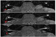 Correlation of semi-quantitative findings of endolymphatic hydrops in MRI with the audiometric findings in patients with Meniere's disease