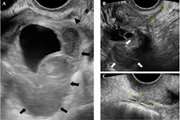 Diagnostic Accuracy of Transvaginal Sonography for Deeply Infiltrating Endometriosis and Pouch of Douglas Obliteration in the Presence or Absence of Ovarian Endometrioma