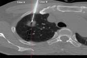 Technical Accuracy of Percutaneous Needle Biopsy of Subcentimeter Pulmonary Nodules under CT Fluoroscopy Guidance and Associated Procedural Complication