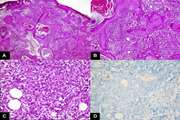 Mycobacterium mageritense subcutaneous infection following cryopreserved facial fat injection: A report of 2 cases