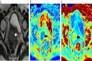 Prediction of lymphovascular space invasion in cervical carcinoma using diffusion kurtosis imaging