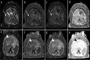 ] Prediction of hepatocellular carcinoma response to transarterial chemoembolization with intravoxel incoherent motion diffusion-weighted imaging