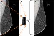 Microcalcification Detection in Mammograms Using Deep Learning