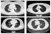 A Multi-centric Evaluation of Deep Learning Models for Segmentation of COVID-19 Lung Lesions on Chest CT Scans