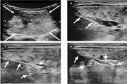 Evaluation of Ethanol Injection, Radiofrequency Ablation, and Levothyroxine Therapy in the Management of Benign Thyroid Nodules