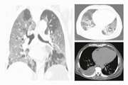 Chest CT scan features to predict COVID-19 patients' outcome and survival