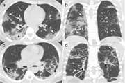 Prognostic Factors of Initial Chest CT Findings for ICU Admission and Mortality in Patients with COVID-19 Pneumonia