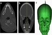 Automatic detection of symmetry plane for computer-aided surgical simulation in craniomaxillofacial surgery