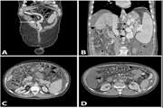 Esophageal variceal hemorrhage: the role of MDCT characteristics in predicting the presence of varices and bleeding risk