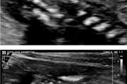 Evaluation of Bi-Iliac Distance and Timing of Ossification of Sacrum by Sonography in the Second Trimester of Pregnancy