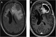 Evaluation of multimodal MR imaging for differentiating infiltrative versus reactive edema in brain gliomas