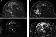 Correlation of Peri-Tumoral Edema Determined in T2 Weighted Imaging with Apparent Diffusion Coefficient of Peritumoral Area in Patients with Breast Carcinoma