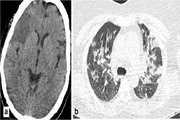 COVID-19-related strokes in adults below 55 years of age: a case series.