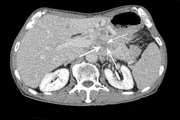 Pancreatic neuroendocrine tumors (pNETs): the predictive value of MDCT characteristics in the differentiation of histopathological grades