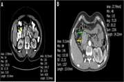 Possible association of vitamin D status with lung involvement and outcome in patients with COVID-19: a retrospective study