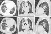 COVID-19 Evaluation by Low-Dose High Resolution CT Scans Protocol.