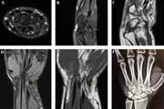 Acute calcific tendinitis of flexor Carpi Ulnaris: A big mimicker and unusual cause of wrist pain with a pictorial review