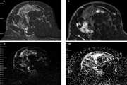 Correlation of apparent diffusion coefficient values and peritumoral edema with pathologic biomarkers in patients with breast cancer