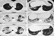 Clinical Course, Imaging Features, and Outcomes of COVID-19 in Kidney Transplant Recipients