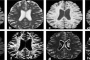  Multiparametric qMTI Assessment and Monitoring of Normal Appearing White Matter and Classified T1 Hypointense Lesions in Relapsing-Remitting Multiple Sclerosis